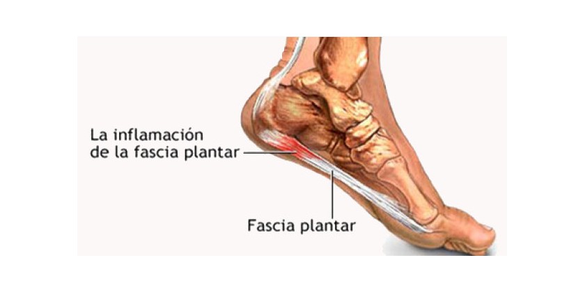 ¿Qué es la fascitis plantar?