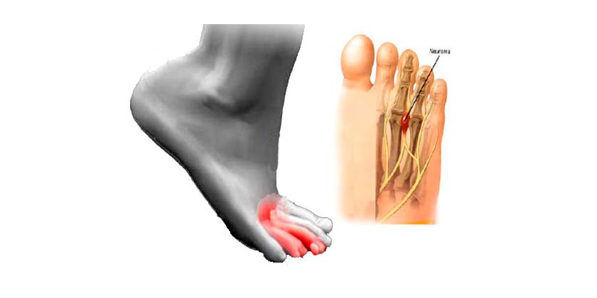 Neuroma de Morton