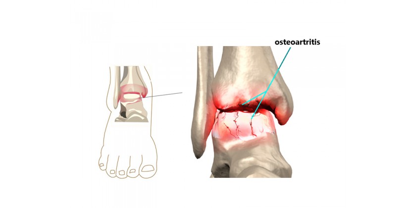 ¿Qué es la osteoartritis?